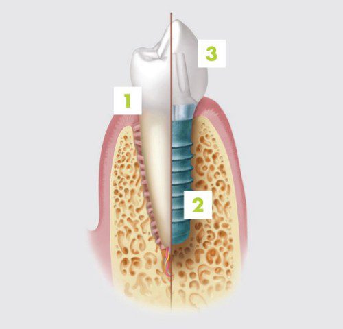 Diagram of implant compared to a natural tooth